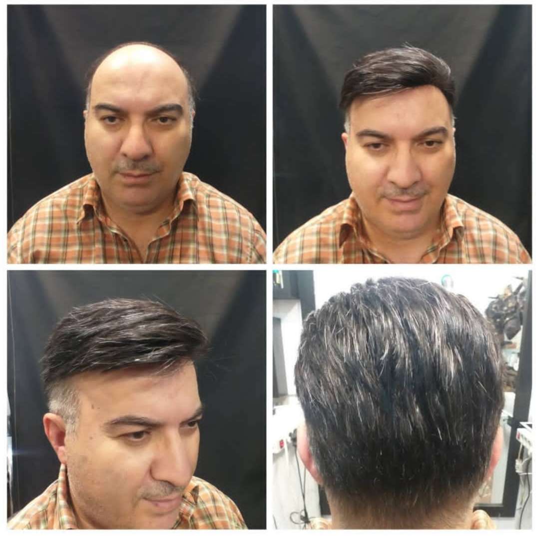 راهکاری نوین برای حل مشکل طاسی و ریزش موهای شدید